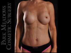 Abdominoplasty, Liposuction, Silicone Breast Augmentation
