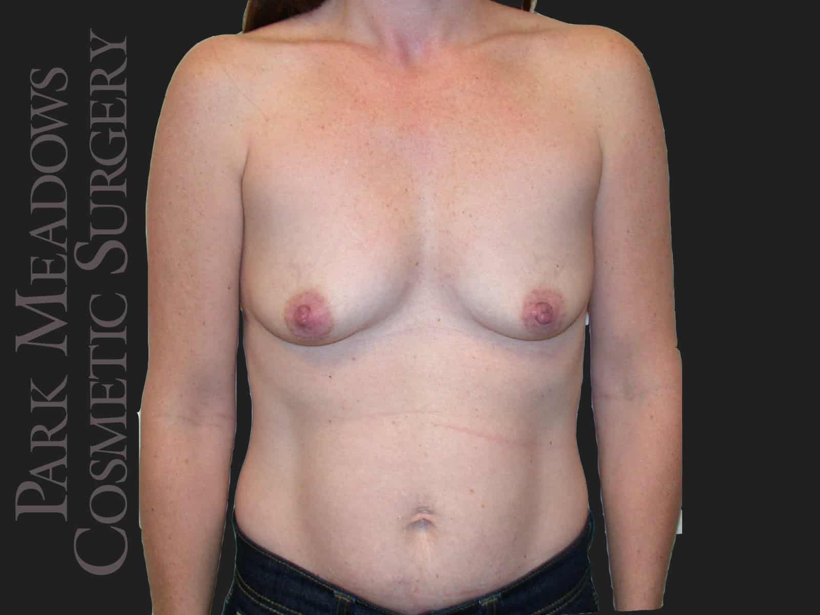 Before Image: Abdominoplasty, Liposuction and Silicone Breast Augmentation - front