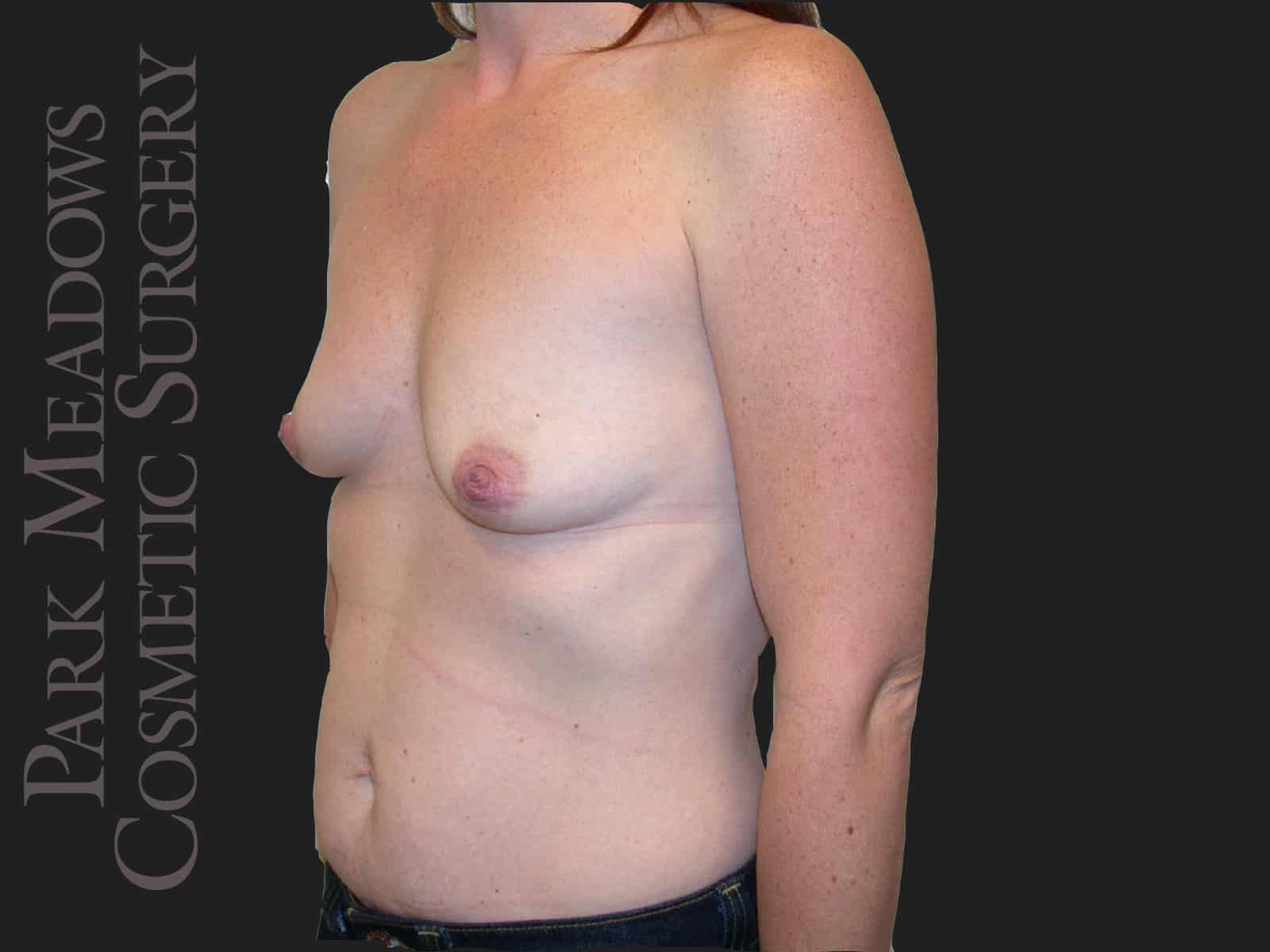 Before Image: Abdominoplasty, Liposuction and Silicone Breast Augmentation - left-front-oblique