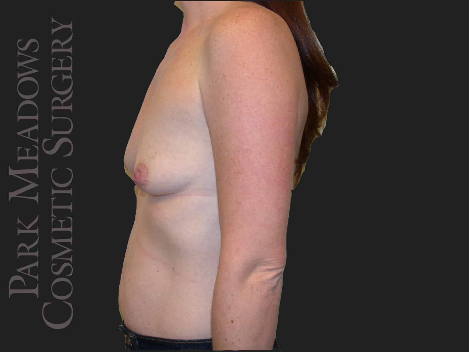 Before Image: Abdominoplasty, Liposuction and Silicone Breast Augmentation - left-side