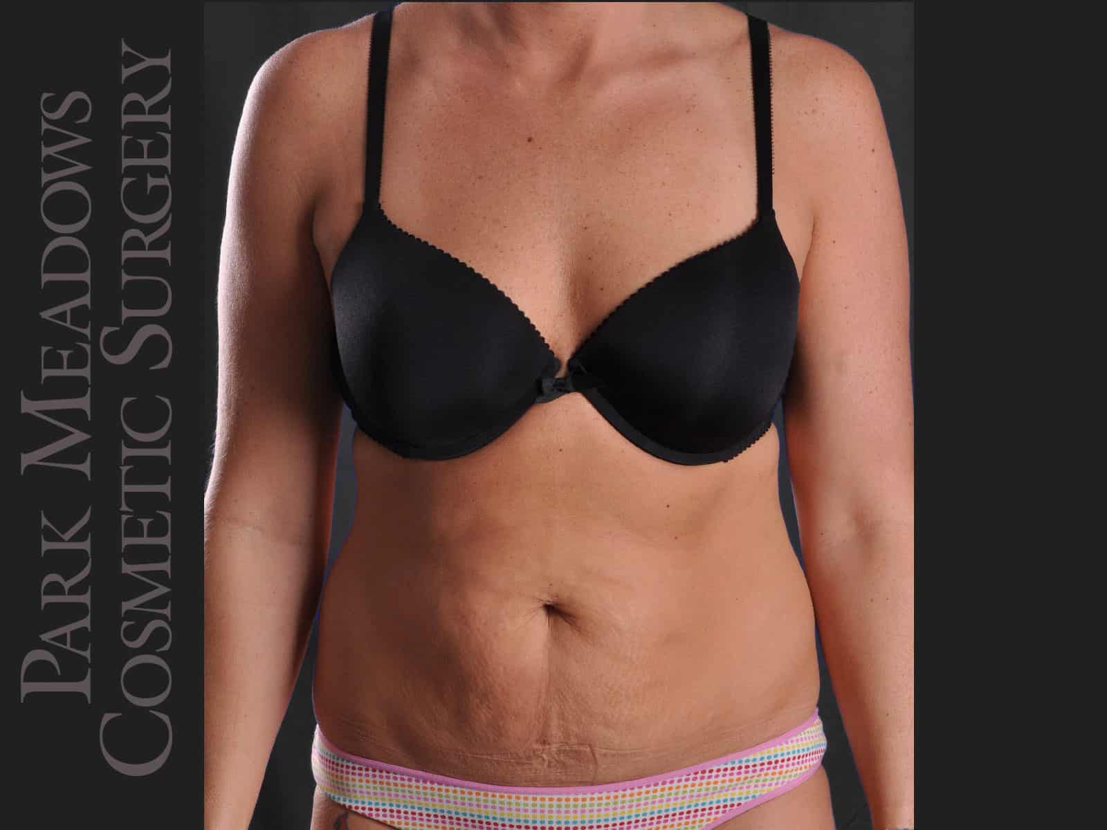 Before Image: Abdominoplasty and Liposuction - front