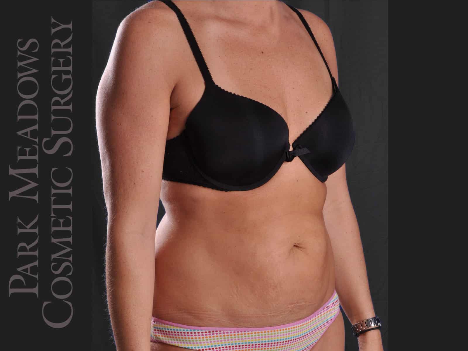 Before Image: Abdominoplasty and Liposuction - right-front-oblique