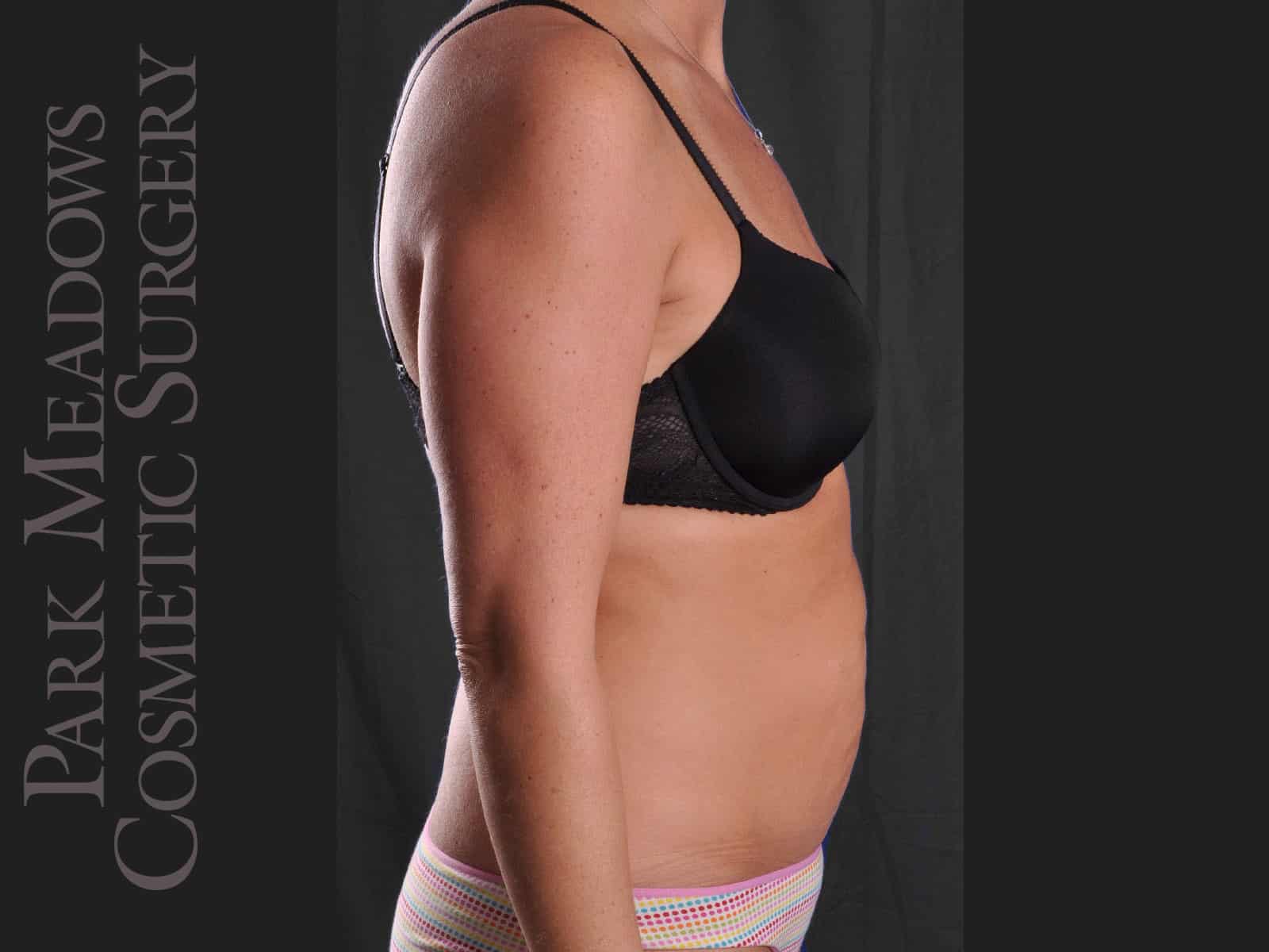 Before Image: Abdominoplasty and Liposuction - right-side