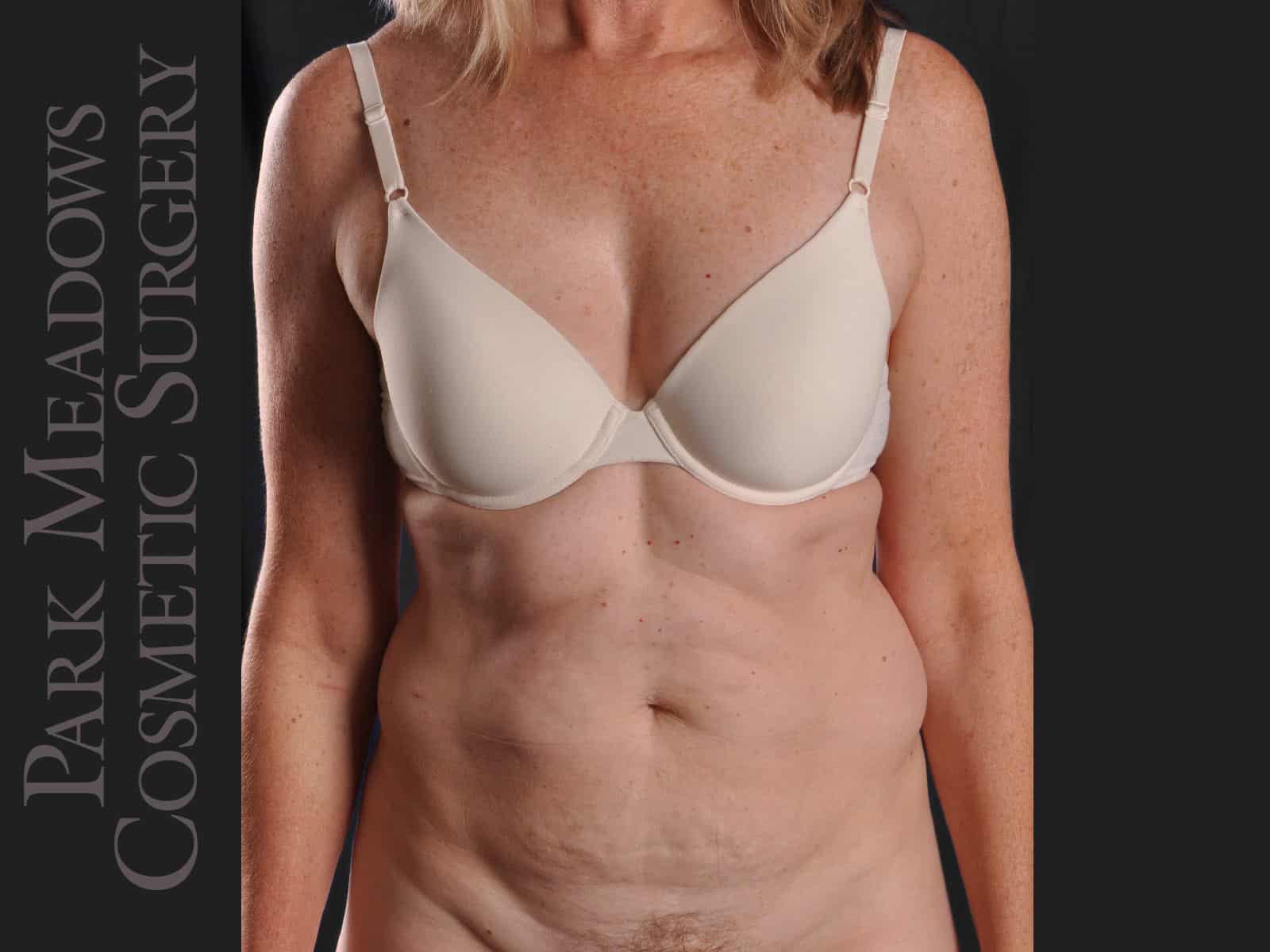 Before Image: Abdominoplasty and Liposuction - front