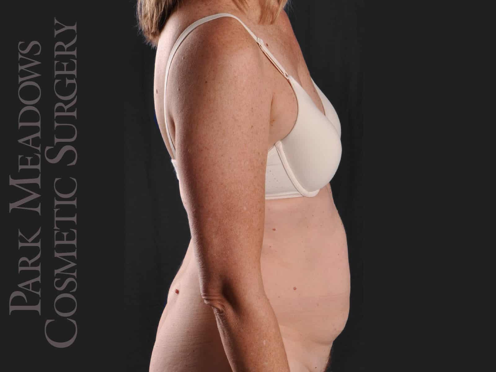 Before Image: Abdominoplasty and Liposuction - right-side