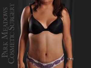 Abdominoplasty and Liposuction