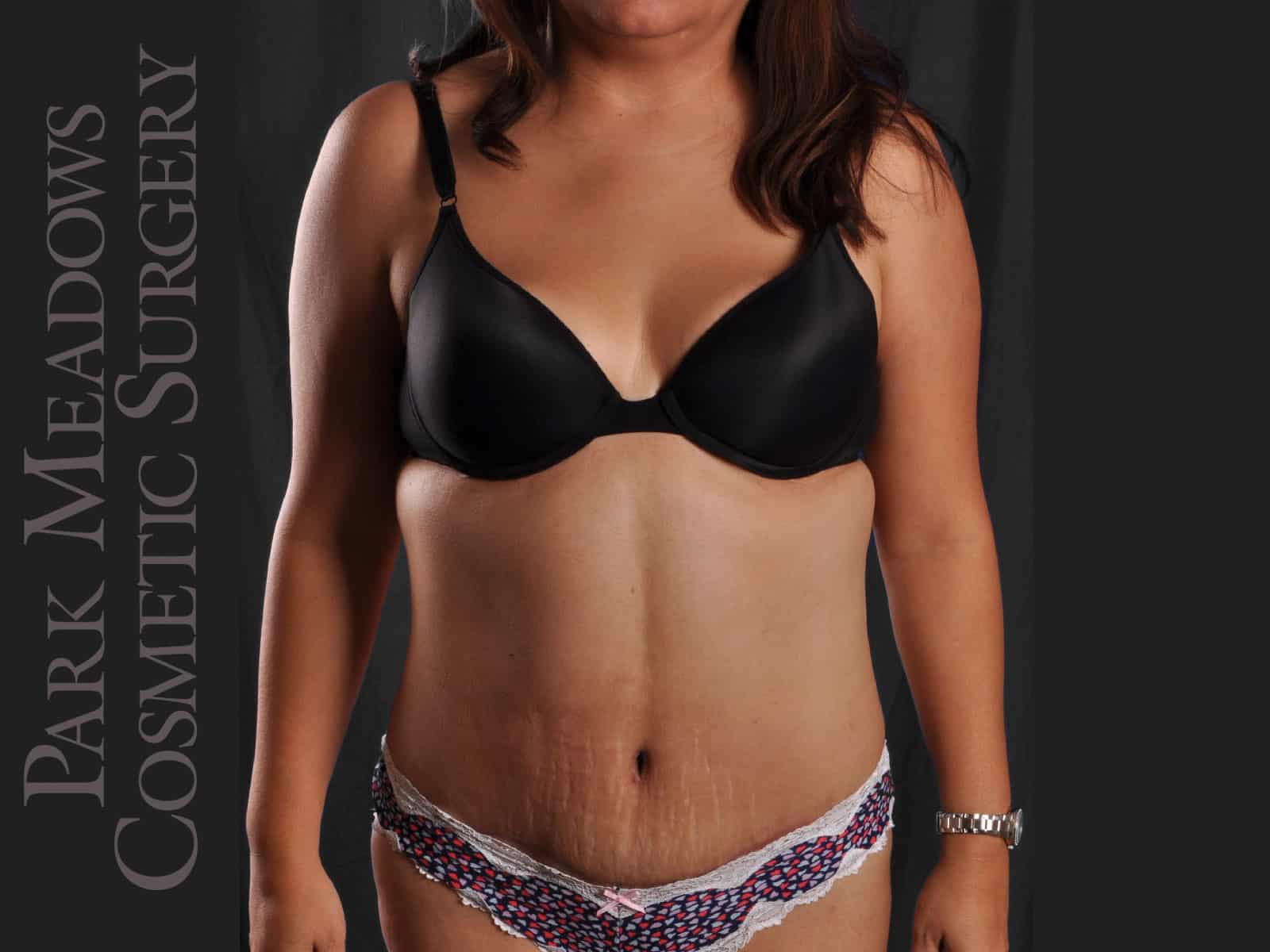 After Image: Abdominoplasty and Liposuction - front