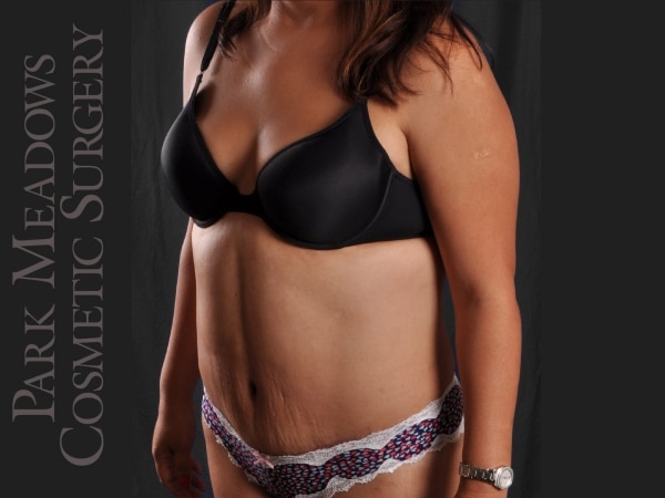 After Image: Abdominoplasty and Liposuction - left-front-oblique