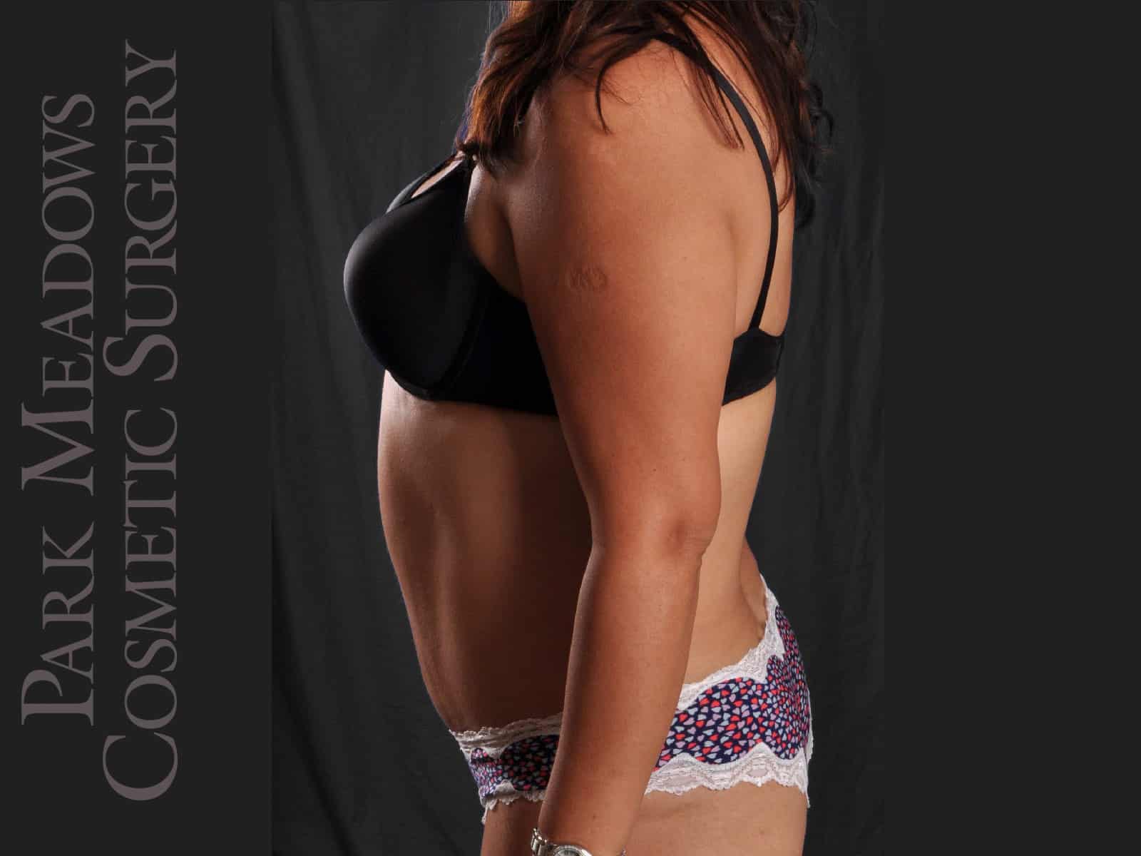 After Image: Abdominoplasty and Liposuction - left-side