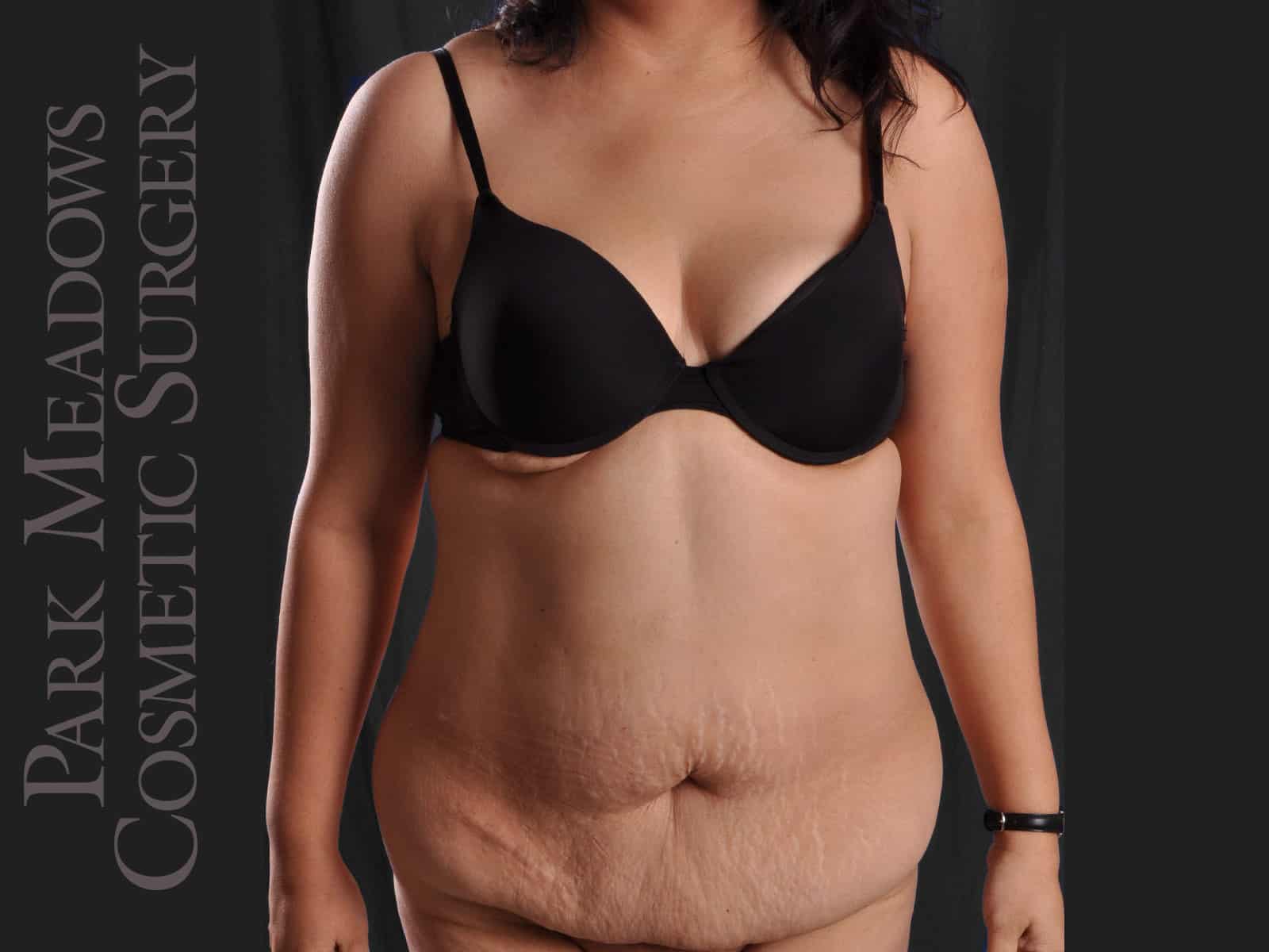 Before Image: Abdominoplasty and Liposuction - front