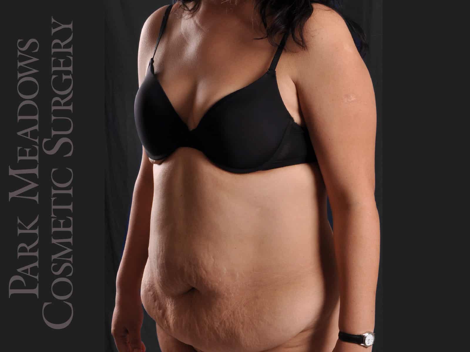 Before Image: Abdominoplasty and Liposuction - left-front-oblique