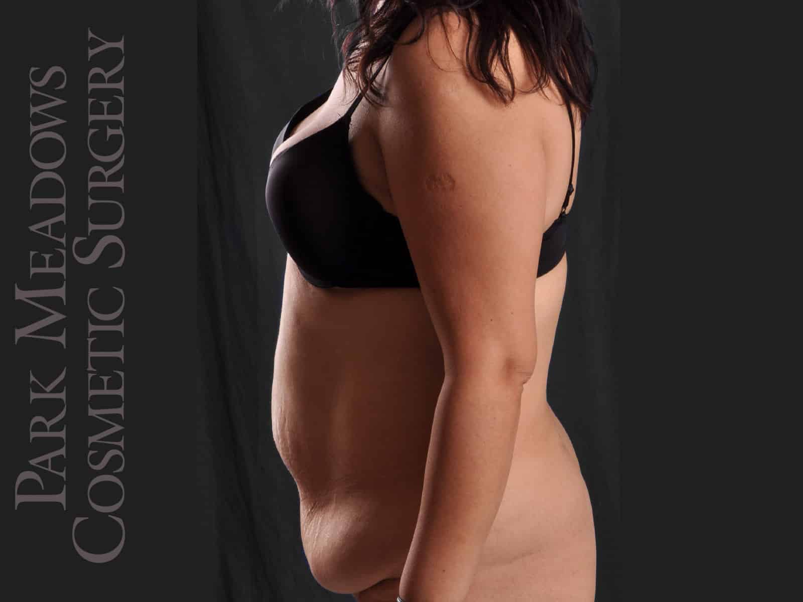 Before Image: Abdominoplasty and Liposuction - left-side
