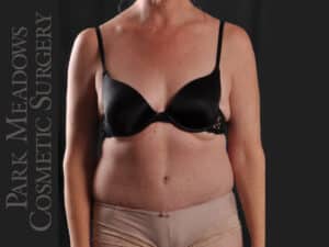 Abdominoplasty and Liposuction