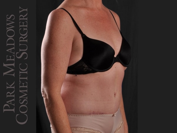 After Image: Abdominoplasty and Liposuction - right-front-oblique