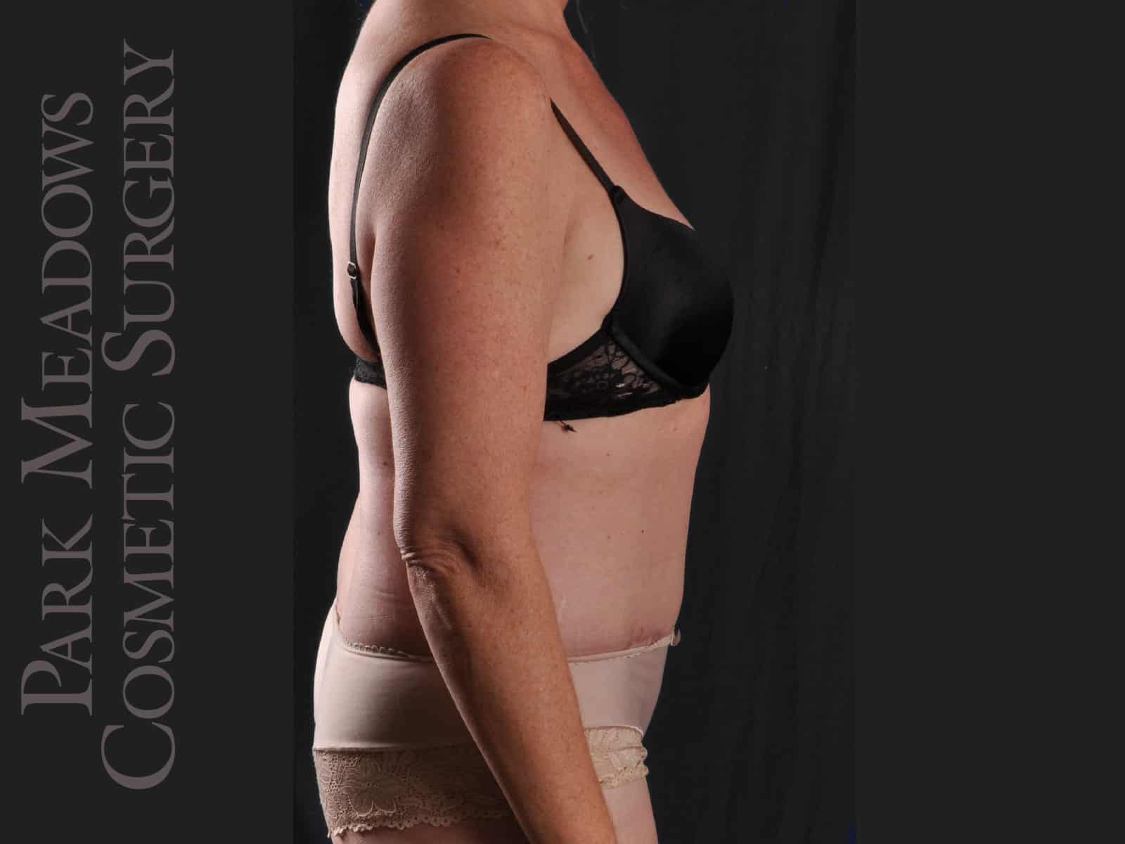 After Image: Abdominoplasty and Liposuction - right-side