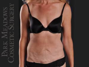 Abdominoplasty and Liposuction