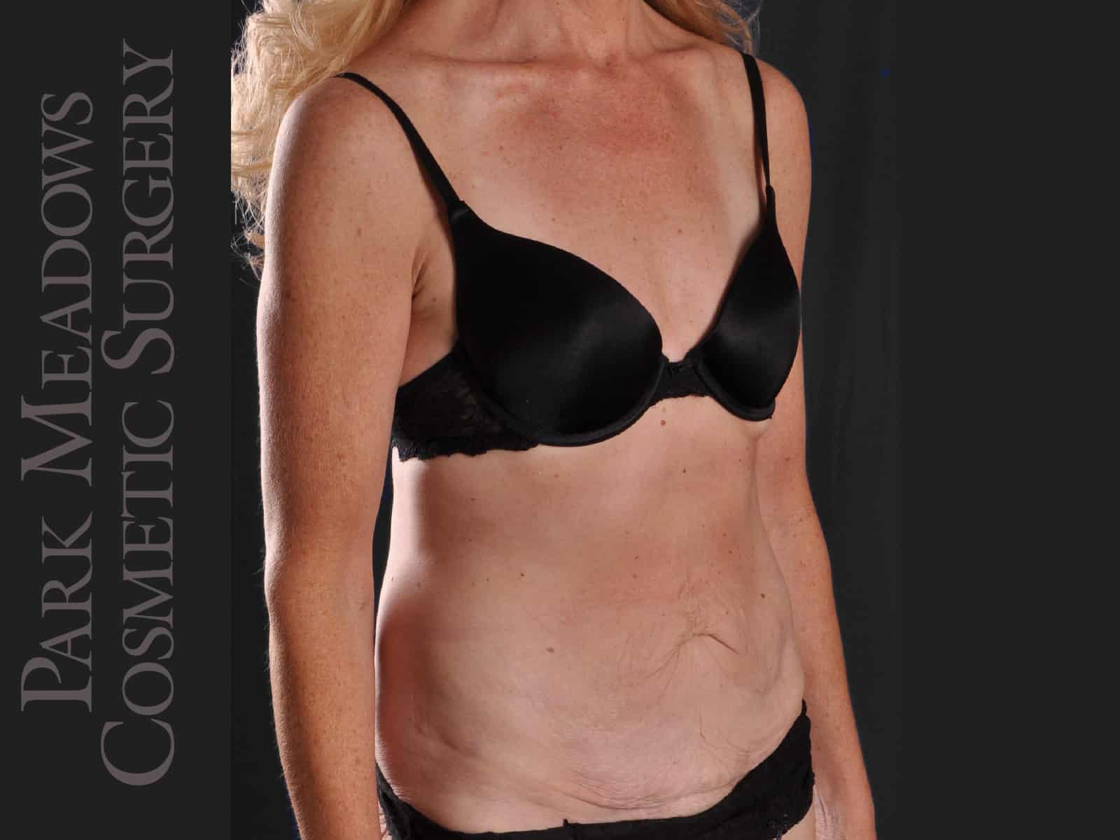 Before Image: Abdominoplasty and Liposuction - right-front-oblique