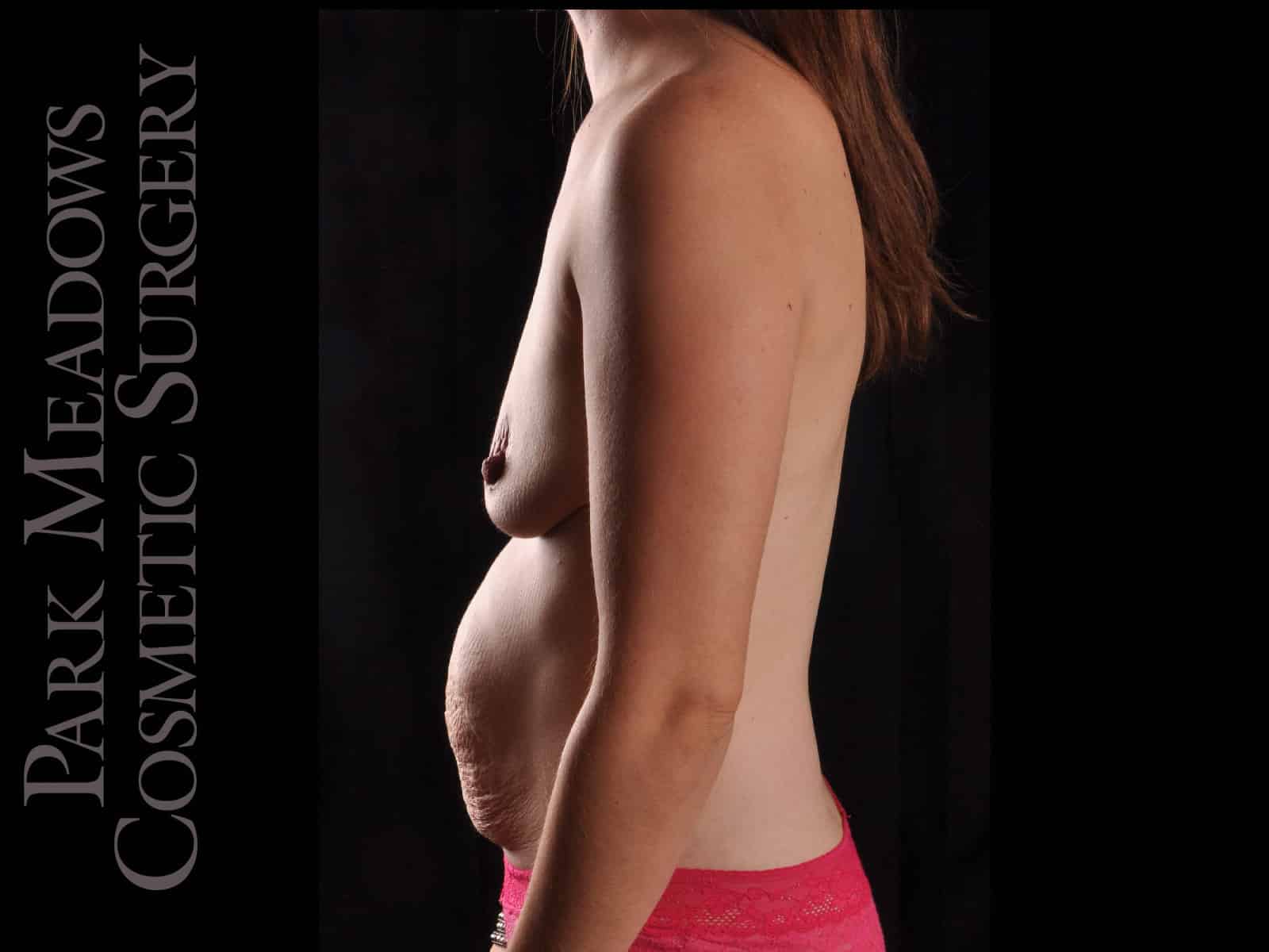 Before Image: Abdominoplasty, Liposuction, and Silicone Breast Augmentation - left-side