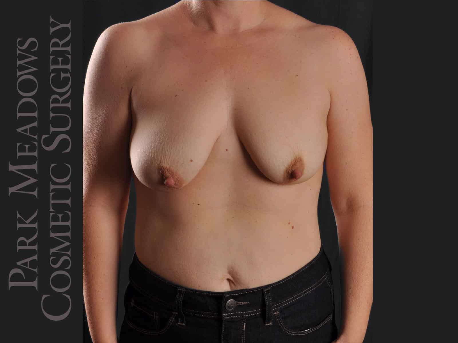 Before Image: Abdominoplasty, Liposuction, Mastopexy with Silicone Breast Augmentation - front