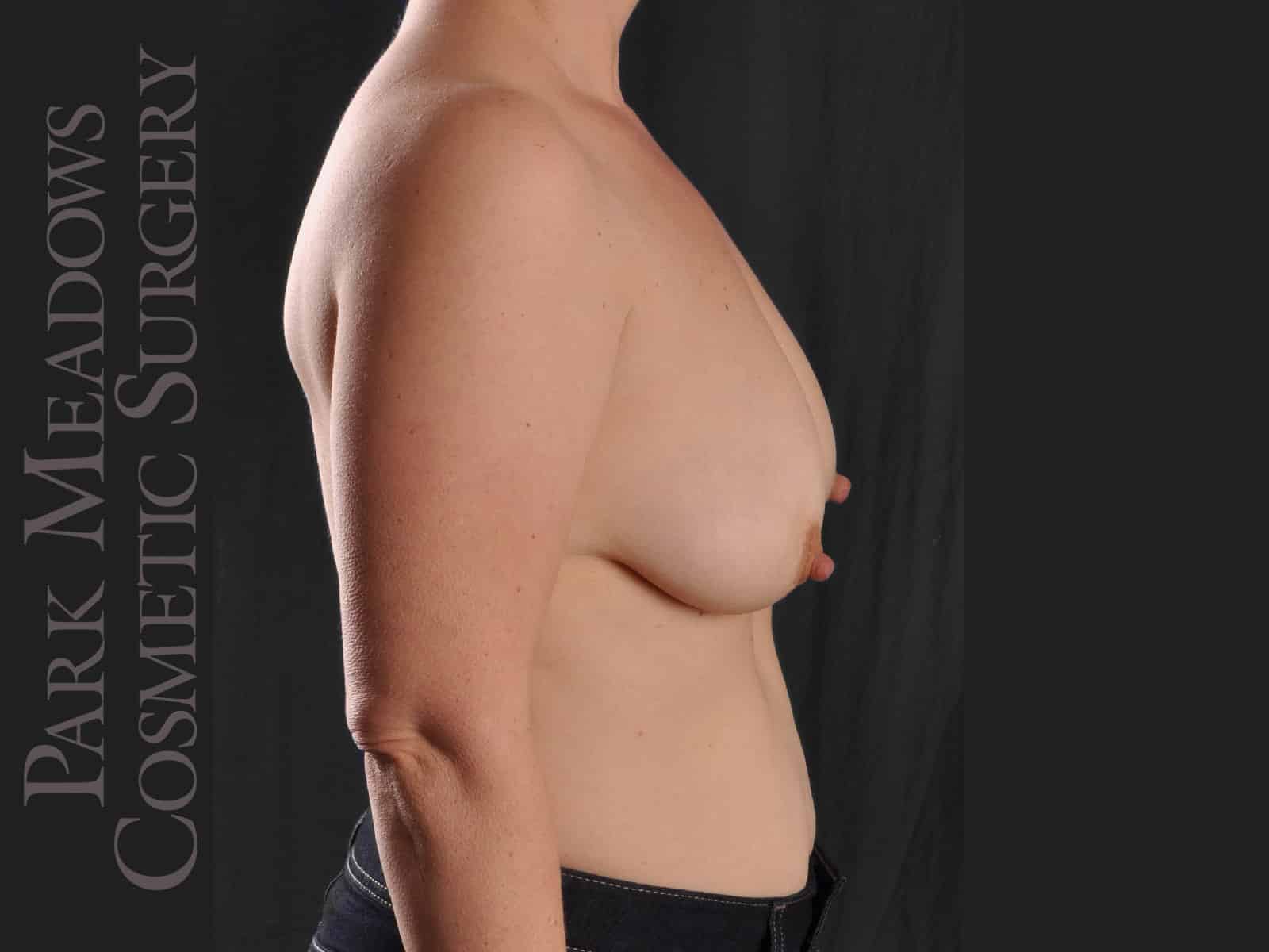 Before Image: Abdominoplasty, Liposuction, Mastopexy with Silicone Breast Augmentation - right-side