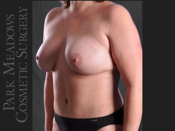 After Image: Abdominoplasty, Liposuction, Mastopexy with Breast Augmentation - left-front-oblique