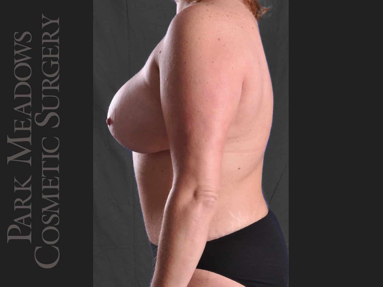 After Image: Abdominoplasty, Liposuction, Mastopexy with Breast Augmentation - left-side