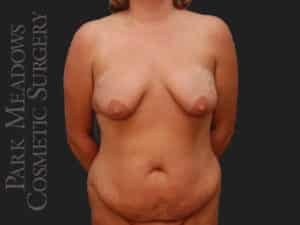 Abdominoplasty, Liposuction, Mastopexy with Breast Augmentation