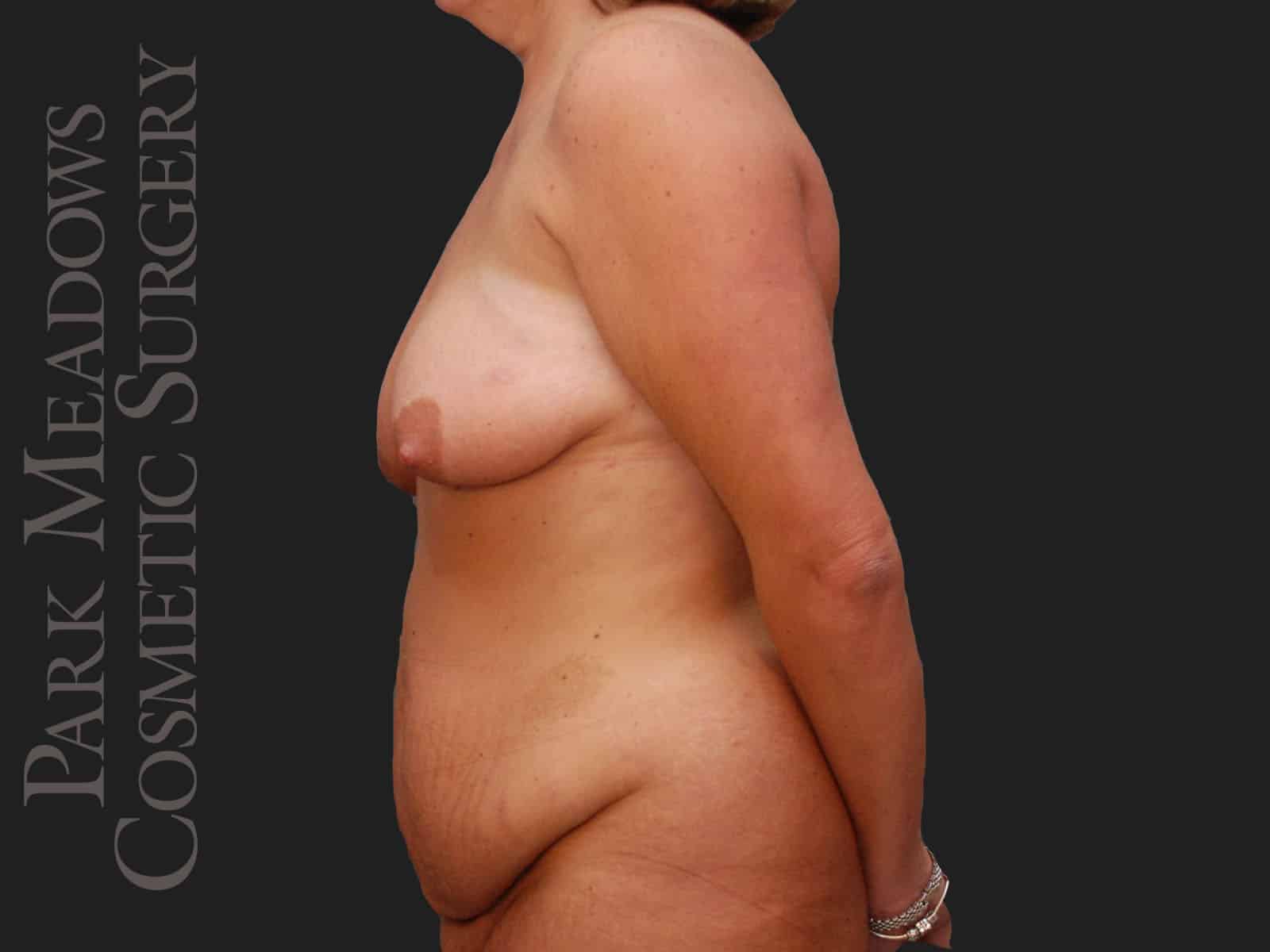 Before Image: Abdominoplasty, Liposuction, Mastopexy with Breast Augmentation - left-side