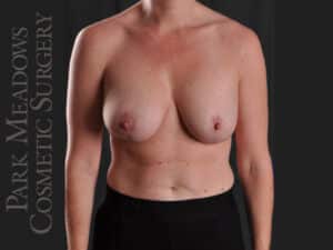 Mastopexy with Silicone Breast Augmentation