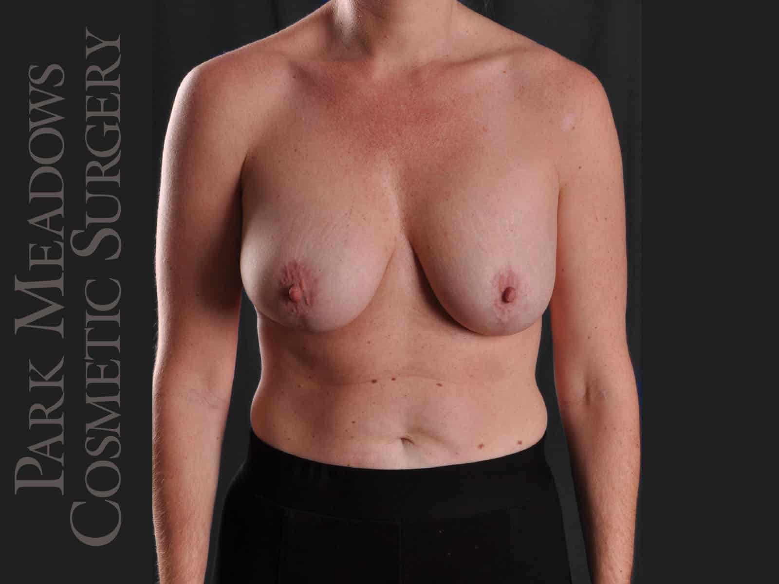 After Image: Mastopexy with Silicone Breast Augmentation - front