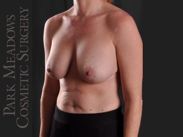 After Image: Mastopexy with Silicone Breast Augmentation - left-front-oblique