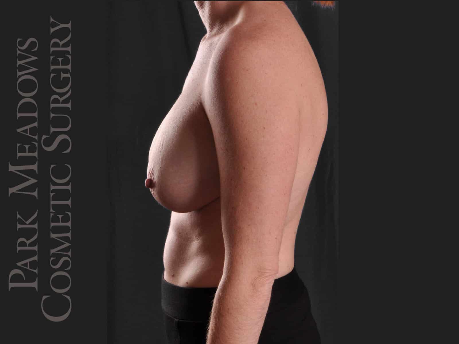 After Image: Mastopexy with Silicone Breast Augmentation - left-side
