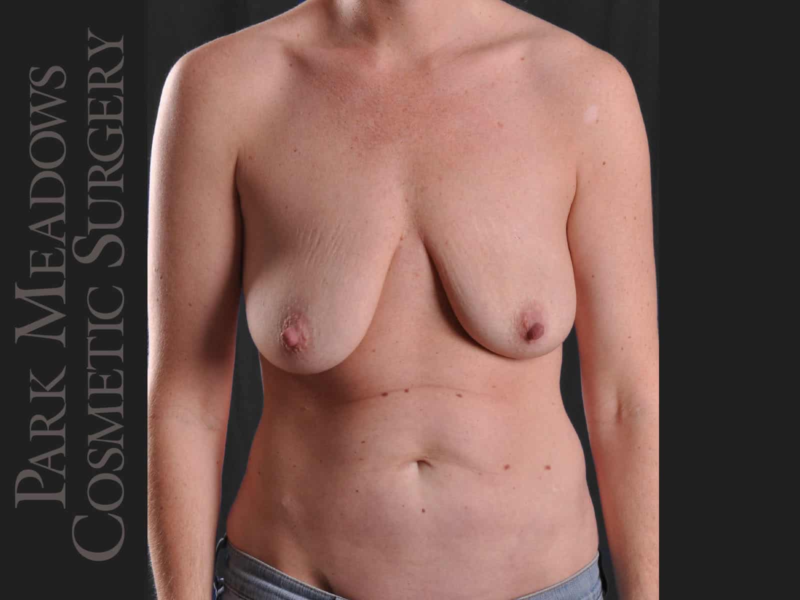 Before Image: Mastopexy with Silicone Breast Augmentation - front