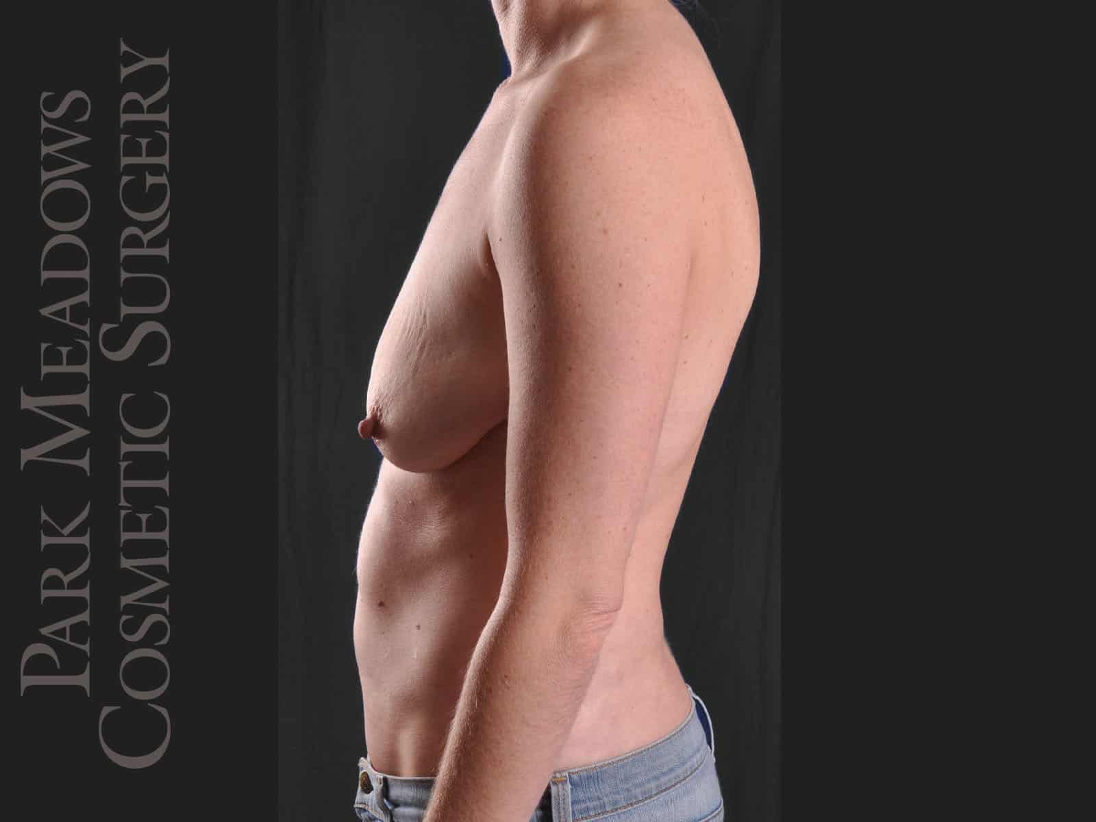 Before Image: Mastopexy with Silicone Breast Augmentation - left-side