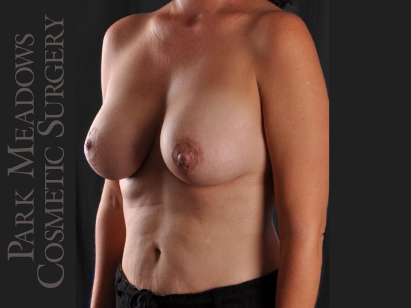 After Image: Mastopexy with Silicone Breast Augmentation - left-front-oblique
