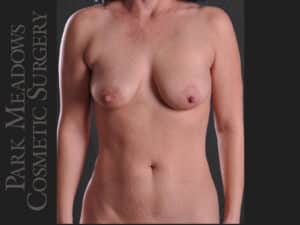 Abdominoplasty, Breast Lift with 275cc (L) and 325cc (R) Silicone Implants