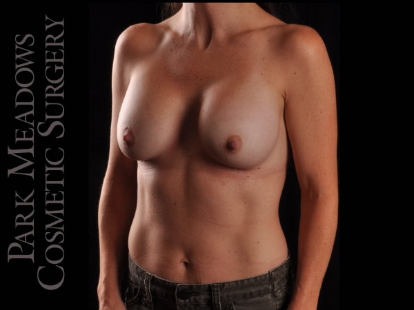 After Image: Silicone Breast Augmentation - left-front-oblique