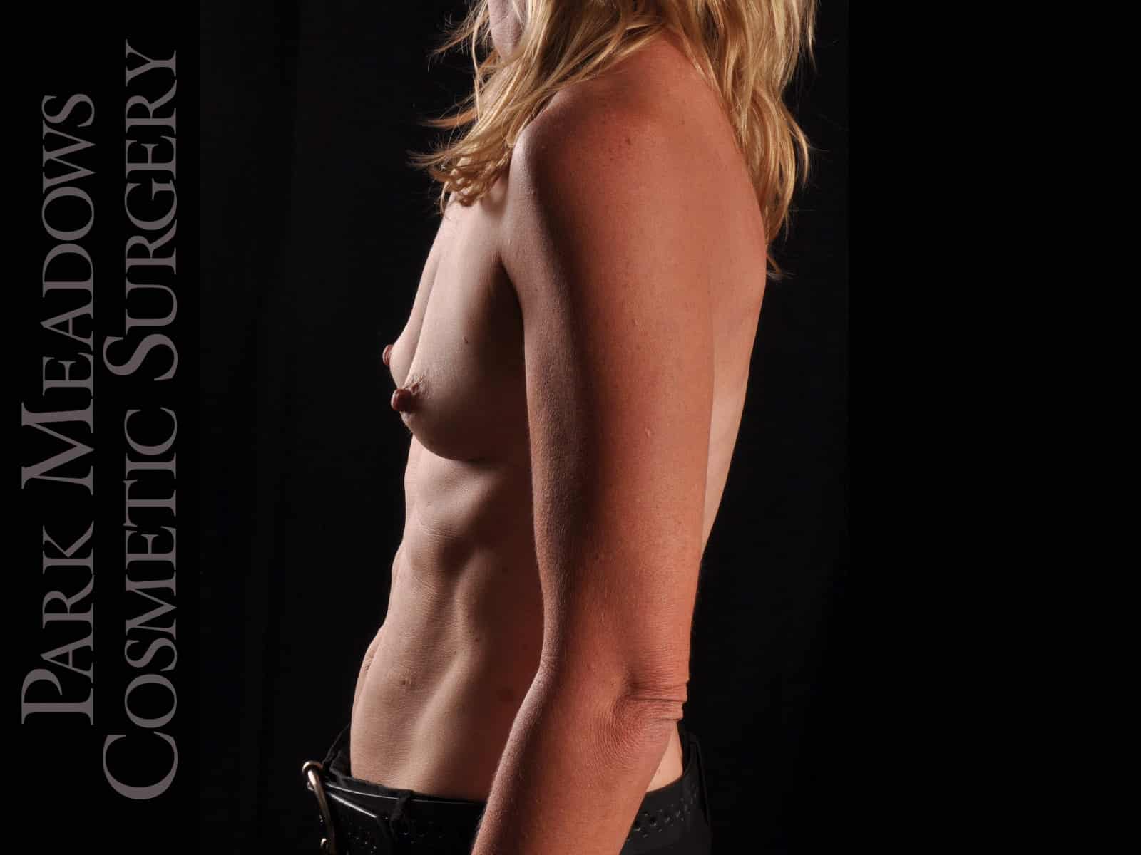 Before Image: Silicone Breast Augmentation - left-side