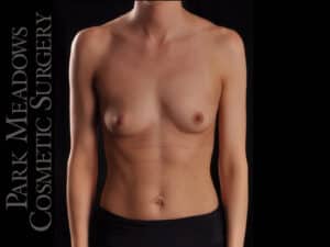 Silicone Breast Augmentation