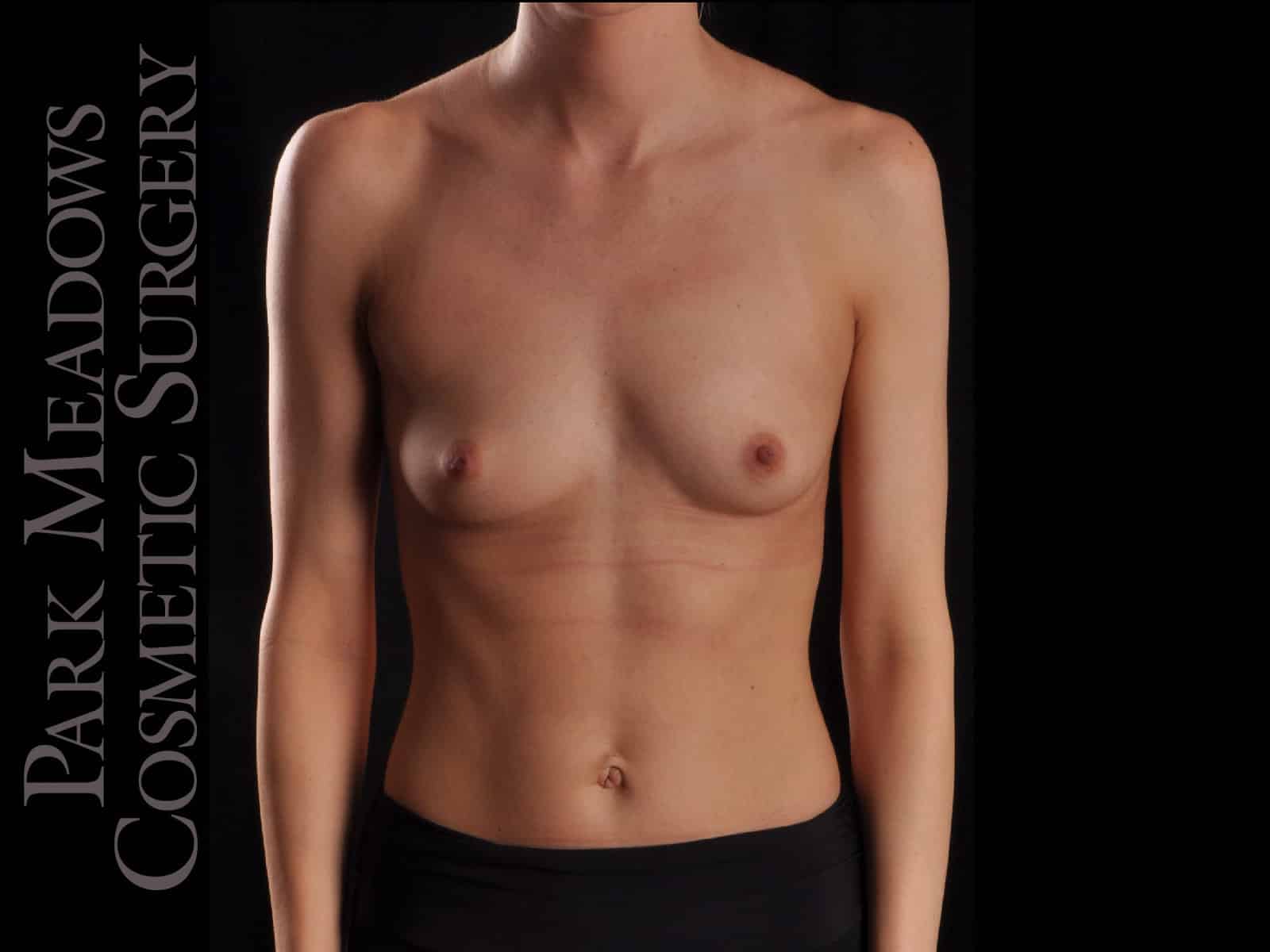 Before Image: Silicone Breast Augmentation - front