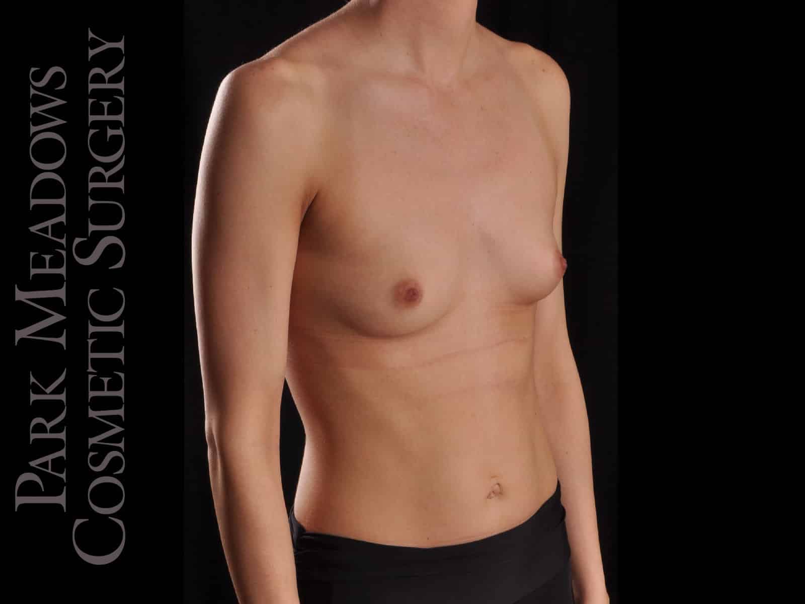 Before Image: Silicone Breast Augmentation - right-front-oblique