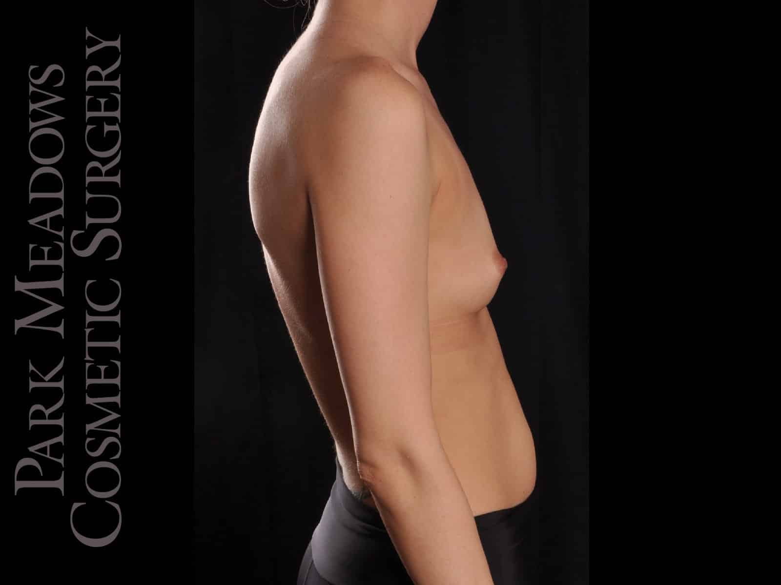 Before Image: Silicone Breast Augmentation - right-side