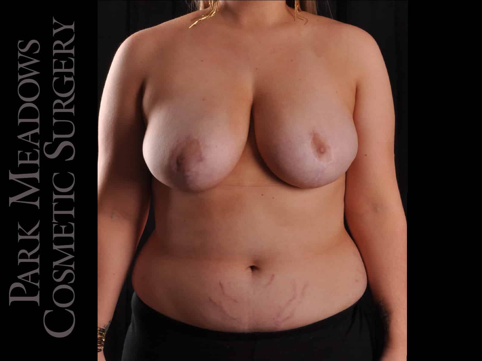 After Image: Cosmetic Breast Reduction - front