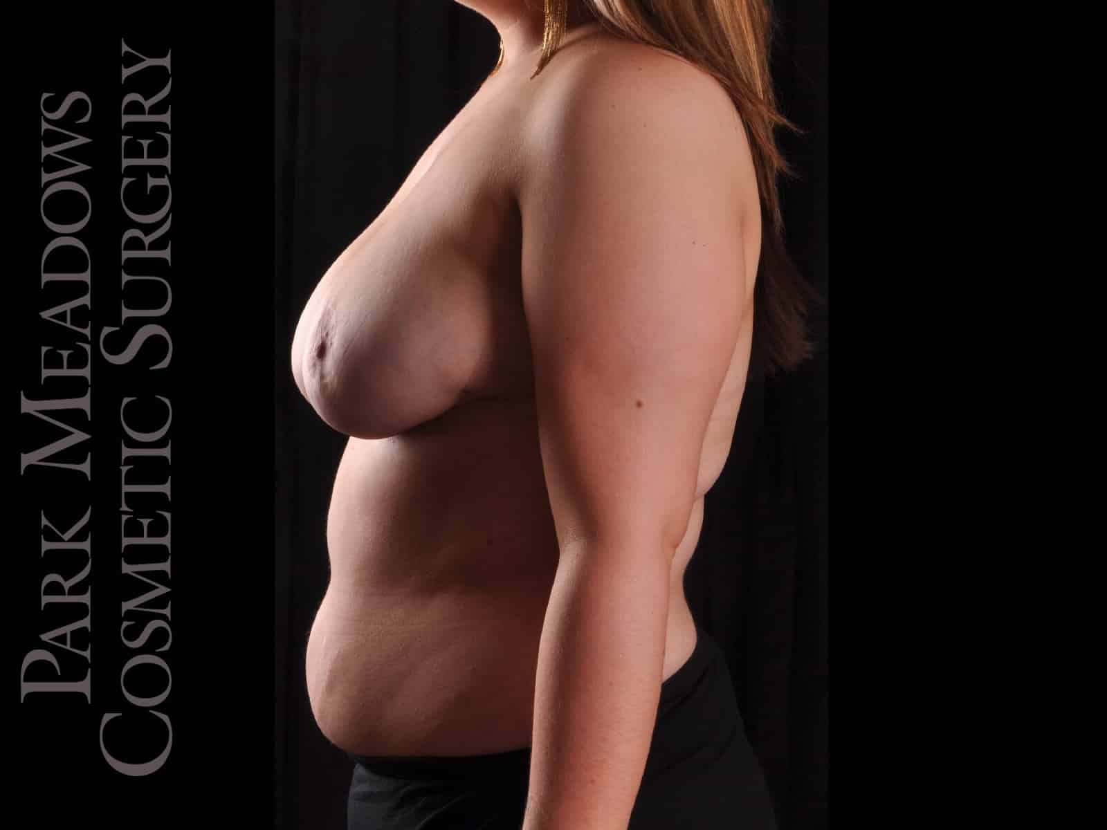 After Image: Cosmetic Breast Reduction - left-side