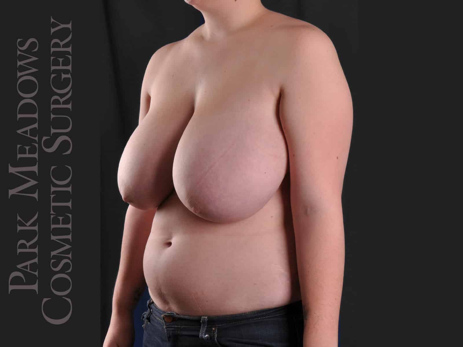 Before Image: Cosmetic Breast Reduction - left-front-oblique