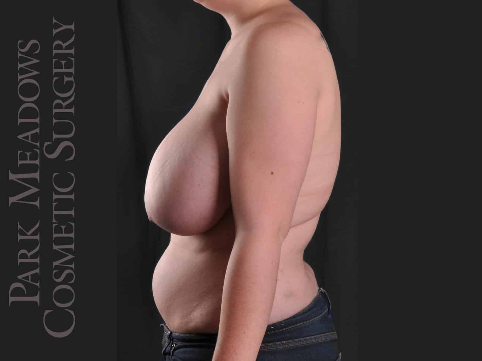 Before Image: Cosmetic Breast Reduction - left-side