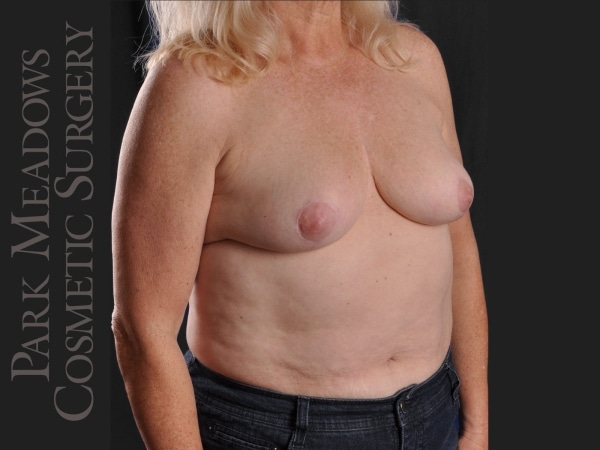 After Image: Cosmetic Breast Reduction - right-front-oblique
