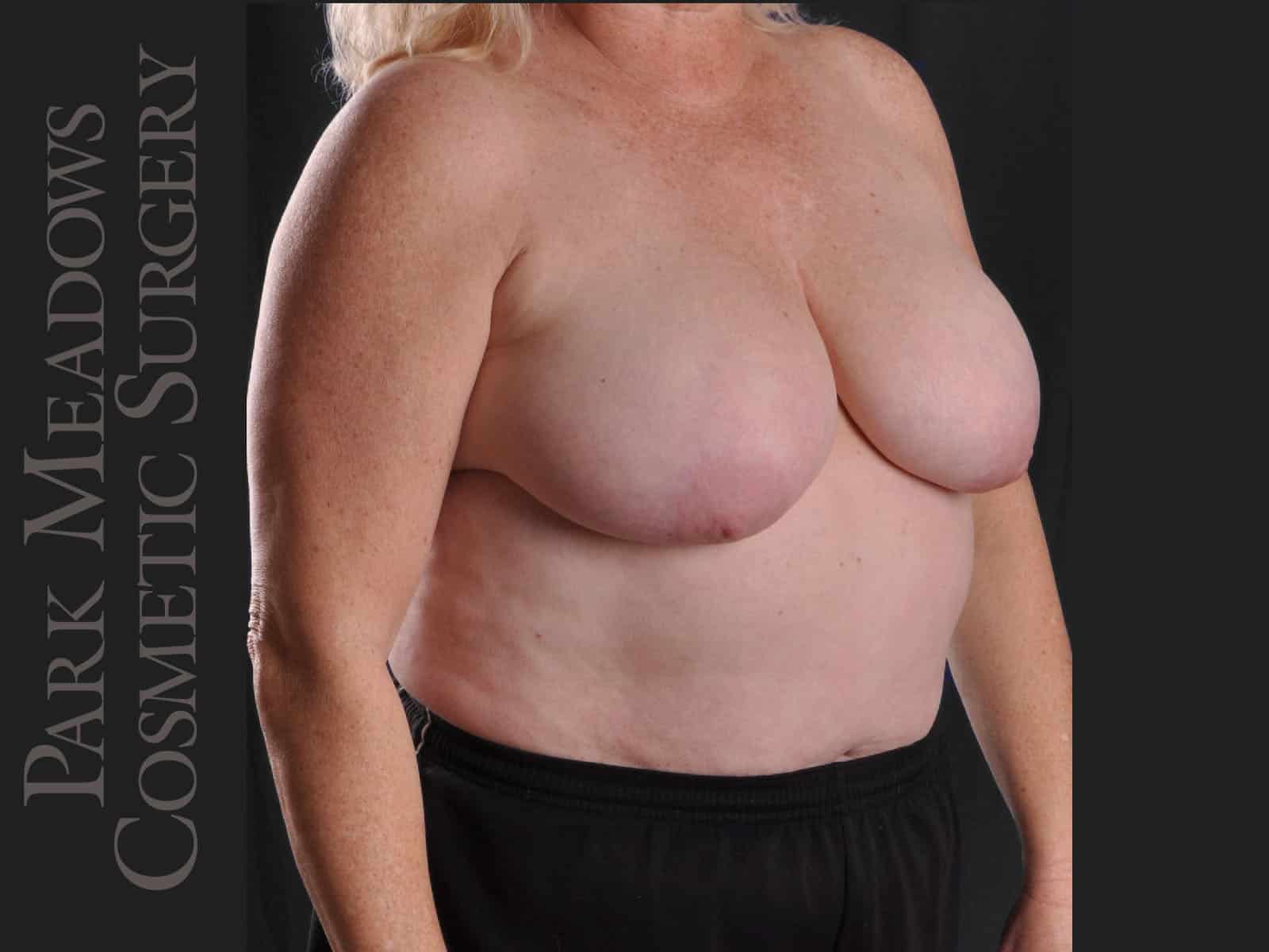 Before Image: Cosmetic Breast Reduction - right-front-oblique