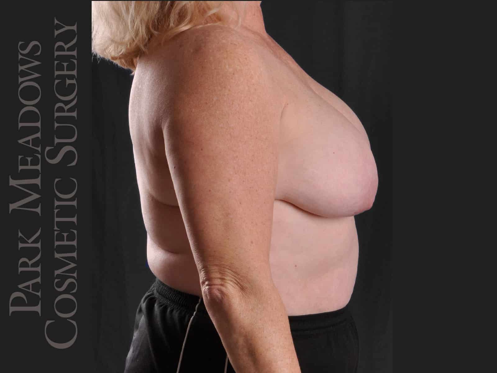 Before Image: Cosmetic Breast Reduction - right-side