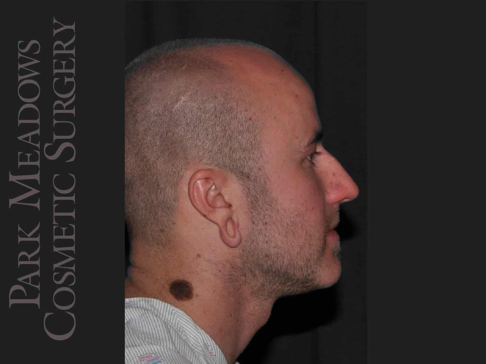 Before Image: Ear Gauge Repair - right-side